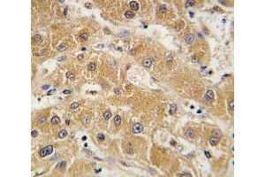 IHC analysis of FFPE human hepatocarcinoma tissue stained with APOA5 antibody (APOA5 Antikörper  (AA 22-52))