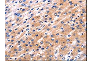 The image on the left is immunohistochemistry of paraffin-embedded Human liver cancer tissue using ABIN7192110(RAB39A Antibody) at dilution 1/5, on the right is treated with synthetic peptide. (RAB39A Antikörper)
