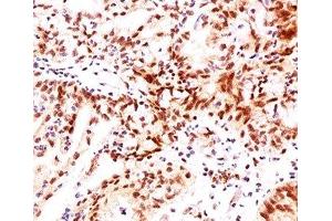 IHC testing of ovarian cancer stained with Estrogen Receptor beta antibody (ERb455). (ESR2 Antikörper  (C-Term))