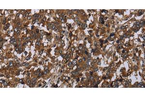 Immunohistochemistry of paraffin-embedded Human liver cancer tissue using HOMER2 Polyclonal Antibody at dilution 1:40 (HOMER2 Antikörper)