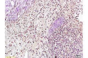 Formalin-fixed and paraffin embedded: human cervical carcinoma labeled with Anti-Runx3 Polyclonal Antibody (ABIN739370), Unconjugated at 1:300, followed by conjugation to the secondary antibody and DAB staining