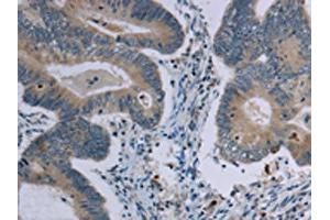 The image on the left is immunohistochemistry of paraffin-embedded Human colon cancer tissue using ABIN7191408(MARVELD1 Antibody) at dilution 1/40, on the right is treated with synthetic peptide. (MARVELD1 Antikörper)