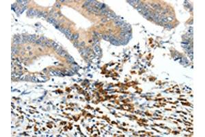 The image on the left is immunohistochemistry of paraffin-embedded Human colon cancer tissue using (PTEN Antibody) at dilution 1/20, on the right is treated with synthetic peptide. (PTEN Antikörper)
