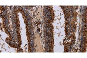 Immunohistochemistry of paraffin-embedded Human colon cancer tissue using PPP1R1B Polyclonal Antibody at dilution 1:50 (DARPP32 Antikörper)