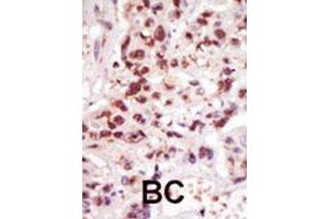 Formalin-fixed and paraffin-embedded human cancer tissue reacted with MAP3K8 polyclonal antibody  , which was peroxidase-conjugated to the secondary antibody, followed by DAB staining. (MAP3K8 Antikörper  (C-Term))