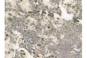 ABIN6257687 and ABIN6274287 at 1/100 staining human melanoma by IHC-P. (CEBPG Antikörper  (Internal Region))