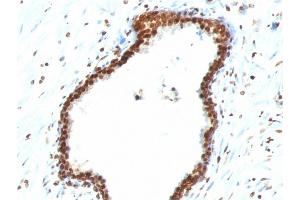 Formalin-fixed, paraffin-embedded human Colon Carcinoma stained with Double Stranded DNA Mouse Monoclonal Antibody (121-3) (dsDNA Antikörper)