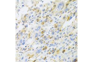 Immunohistochemistry of paraffin-embedded human liver cancer using CXCR3 Antibody. (CXCR3 Antikörper)