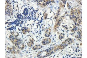 ABIN4902755 (5µg/ml) staining of paraffin embedded Human Breast cancer. (ROR1 Antikörper)