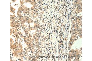 Immunohistochemistry of Human gastric cancer using TRPM5 Polyclonal Antibody at dilution of 1:60 (TRPM5 Antikörper)