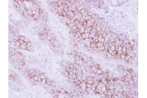 IHC-P Image Immunohistochemical analysis of paraffin-embedded human breast cancer, using KIR2DL4, antibody at 1:250 dilution.