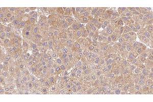 ABIN6277669 at 1/100 staining Human Melanoma tissue by IHC-P. (CCL5 Antikörper  (Internal Region))