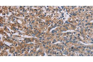 Immunohistochemistry of paraffin-embedded Human prostate cancer using PLXND1 Polyclonal Antibody at dilution of 1:40 (PLXND1 Antikörper)