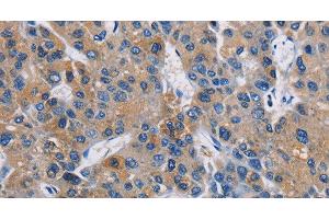 Immunohistochemistry of paraffin-embedded Human liver cancer using GPM6A Polyclonal Antibody at dilution of 1:40 (GPM6A Antikörper)