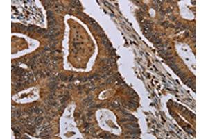The image on the left is immunohistochemistry of paraffin-embedded Human colon cancer tissue using ABIN7191460(MIG7 Antibody) at dilution 1/35, on the right is treated with synthetic peptide. (TOX4 Antikörper)
