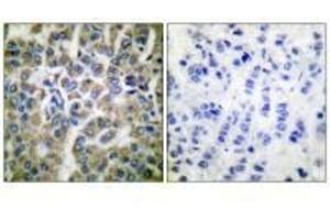 Immunohistochemical analysis of paraffin-embedded human breast carcinoma tissue using HSP10 antibody. (HSPE1 Antikörper)