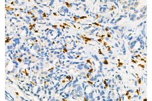 ABIN6258709 and ABIN6275128 at 1/100 staining Human pancreatic cancer and adjacent non-tumor tissue by IHC-P.