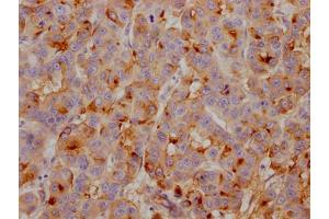 IHC image of ABIN7127430 diluted at 1:100 and staining in paraffin-embedded human breast cancer performed on a Leica BondTM system. (Rekombinanter Clusterin Antikörper)