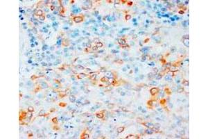 Immunohistochemical staining of VEGFA on formalin fixed, paraffin embedded human esophageal squamous cell carcinoma (ESCC) in cytoplasm DAB chromogenic reaction.