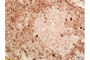 Formalin-fixed and paraffin embedded human melanoma labeled with Anti-CITED1/ABCC1 Polyclonal Antibody, Unconjugated (ABIN682543) at 1:200, followed by conjugation to the secondary antibody and DAB staining (CITED1 Antikörper  (AA 121-193))