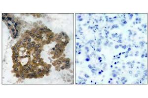 Immunohistochemical analysis of paraffin-embedded human lung carcinoma tissue using Akt2 (phospho- Ser474) antibody (E011124). (AKT2 Antikörper  (pSer474))