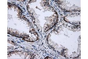 Immunohistochemical staining of paraffin-embedded Adenocarcinoma of breast tissue using anti-PTPRE mouse monoclonal antibody. (PTPRE Antikörper)