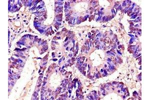 Immunohistochemistry of paraffin-embedded human colon cancer using ABIN7173542 at dilution of 1:100 (C22orf28 Antikörper  (AA 52-229))