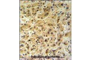 GNS Antibody (Center ) (ABIN390494 and ABIN2840853) IHC analysis in formalin fixed and paraffin embedded human hepatocarcinoma followed by peroxidase conjugation of the secondary antibody and DAB staining. (GNS Antikörper  (AA 174-203))