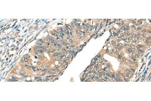 Immunohistochemistry of paraffin-embedded Human colorectal cancer tissue using AIFM2 Polyclonal Antibody at dilution of 1:40(x200) (AIFM2 Antikörper)
