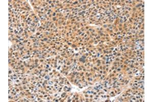 The image on the left is immunohistochemistry of paraffin-embedded Human lung cancer tissue using ABIN7129182(DDX4 Antibody) at dilution 1/20, on the right is treated with fusion protein. (DDX4 Antikörper)