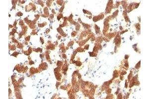 Formalin-fixed, paraffin-embedded human thyroid carcinoma stained with Cytokeratin 18 antibody (KRT18/834).