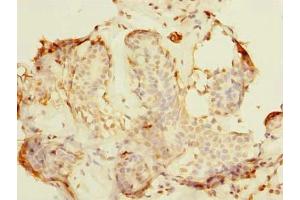 Immunohistochemistry of paraffin-embedded human breast cancer using ABIN7161600 at dilution of 1:100