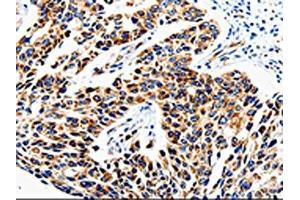 The image is immunohistochemistry of paraffin-embedded Human lung cancer tissue using ABIN7129010(COX16 Antibody) at dilution 1/50. (COX16 Antikörper)