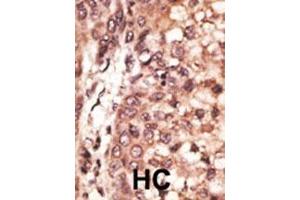 Formalin-fixed and paraffin-embedded human cancer tissue reacted with the primary antibody, which was peroxidase-conjugated to the secondary antibody, followed by DAB staining. (CREB3L1 Antikörper  (C-Term))