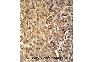ZC3HAV1 Antibody (C-term) (ABIN651882 and ABIN2840438) immunohistochemistry analysis in formalin fixed and paraffin embedded human cervix carcinoma followed by peroxidase conjugation of the secondary antibody and DAB staining. (ZC3HAV1 Antikörper  (C-Term))