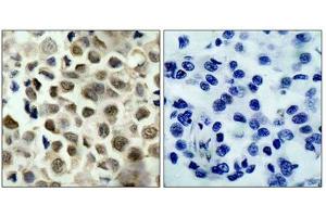Immunohistochemical analysis of paraffin-embedded human lung carcinoma tissue using HDAC8(Phospho-Ser39) Antibody(left) or the same antibody preincubated with blocking peptide(right). (HDAC8 Antikörper  (pSer39))