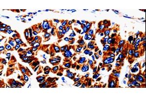 Immunohistochemistry of paraffin-embedded Human lung cancer tissue using UTS2 Polyclonal Antibody at dilution 1:50 (Urotensin 2 Antikörper)
