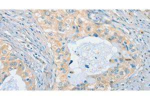 Immunohistochemistry of paraffin-embedded Human cervical cancer using CHRNA2 Polyclonal Antibody at dilution of 1:40 (CHRNA2 Antikörper)