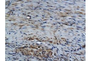 Formalin-fixed and paraffin embedded human colon carcinoma labeled with Rabbit Anti GM-CSF Polyclonal Antibody, Unconjugated  at 1:200 followed by conjugation to the secondary antibody and DAB staining