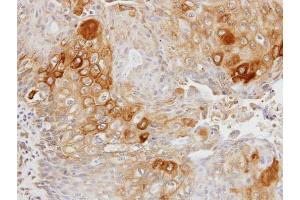IHC-P Image Immunohistochemical analysis of paraffin-embedded OVCA xenograft, using Glycerol kinase 2, antibody at 1:100 dilution. (GK2 Antikörper)