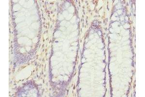 Immunohistochemistry of paraffin-embedded human colon cancer using ABIN7168204 at dilution of 1:100 (RPS6KL1 Antikörper  (AA 1-130))