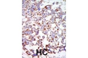 Formalin-fixed and paraffin-embedded human cancer tissue reacted with the primary antibody, which was peroxidase-conjugated to the secondary antibody, followed by AEC staining. (TR4 Antikörper  (C-Term))