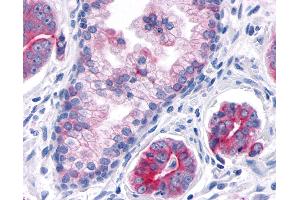 Anti-TNIK antibody IHC of human Prostate, Carcinoma. (TNIK Antikörper  (Internal Region))