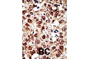 Formalin-fixed and paraffin-embedded human cancer tissue reacted with FDFT1 polyclonal antibody  , which was peroxidase-conjugated to the secondary antibody, followed by DAB staining . (FDFT1 Antikörper  (Internal Region))
