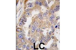 Formalin-fixed and paraffin-embedded human lung carcinoma tissue reacted with AGR2 antibody (Center), which was peroxidase-conjugated to the secondary antibody, followed by DAB staining.