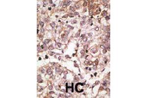 Formalin-fixed and paraffin-embedded human hepatocellular carcinoma tissue reacted with SIGLEC7 polyclonal antibody  , which was peroxidase-conjugated to the secondary antibody, followed by AEC staining. (SIGLEC7 Antikörper  (N-Term))