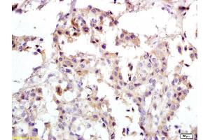 Formalin-fixed and paraffin embedded human breast carcinoma labeled with Anti-PRKCDBP Polyclonal Antibody, Unconjugated (ABIN762206) at 1:200 followed by conjugation to the secondary antibody and DAB staining (PRKCDBP Antikörper  (AA 151-250))