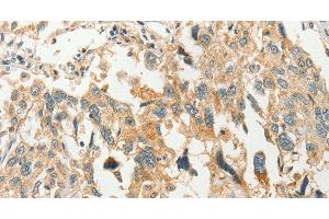 Immunohistochemistry of paraffin-embedded Human esophagus cancer tissue using SLC11A2 Polyclonal Antibody at dilution 1:50 (SLC11A2 Antikörper)