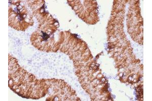 Formalin-fixed, paraffin-embedded human Rectal Mass stained with EpCAM Mouse Recombinant Monoclonal Antibody (rEGP40/1372). (Rekombinanter EpCAM Antikörper  (Extracellular Domain))