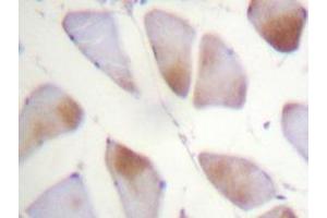 Immunohistochemistry analyzes of Crystallin-αB antibody in paraffin-embedded human breast carcinoma tissue. (CRYAB Antikörper)